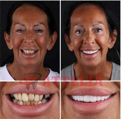 Dental Veneers in Turkey .